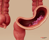 Abbott reports new real-world evidence linking Cologuard screening to lower colorectal cancer incidence and odds of death