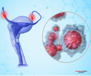 Anixa Biosciences announces first case of stable disease for three months in ovarian cancer CAR-T clinical trial